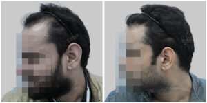 fue hair transplant