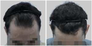 fue hair transplant