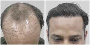 repair hair transplant