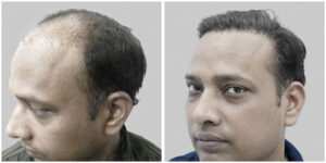 repair hair transplant