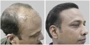 repair hair transplant