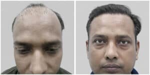 repair hair transplant
