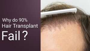 hair transplant