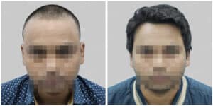 repair hair transplant