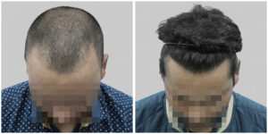 repair hair transplant