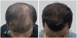 hair transplant before and after