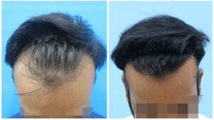 hair transplant results before and after