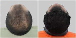 repair hair transplant