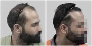 repair hair transplant