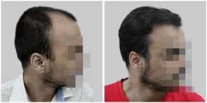 fue hair transplant