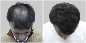 repair hair transplant