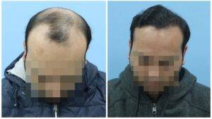 hair transplant before after results