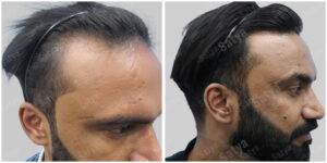 hair transplant before after results