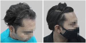 repair hair transplant