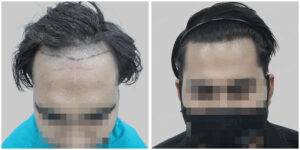 repair hair transplant