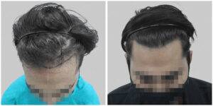 repair hair transplant