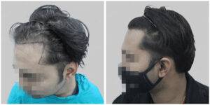 repair hair transplant