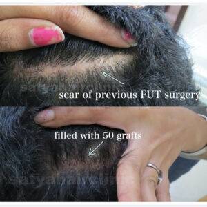 scar repair