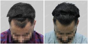 hair transplant before after results