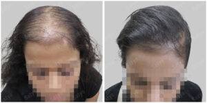 female hair transplant - Satya hair solutions
