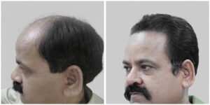 repair hair transplant