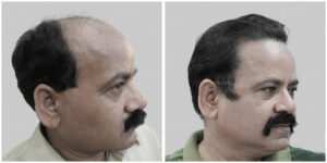 repair hair transplant