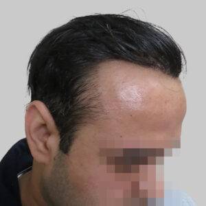 men hair transplant - Satya hair solutions