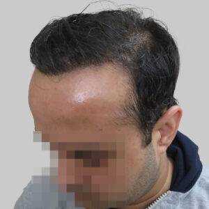 men hair transplant - Satya hair solutions