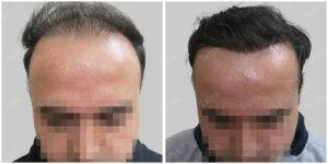 men hair line - Satya hair solutions