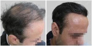 men hair line - Satya hair solutions