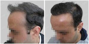 men hair line - Satya hair solutions