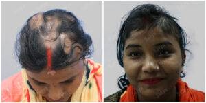 Female hair transplant surgery