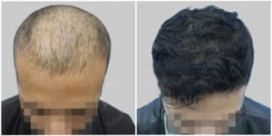 synthetic hair implant