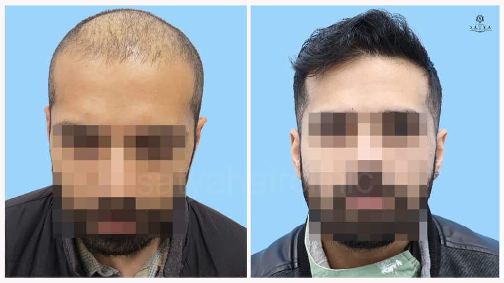 synthetic hair implant