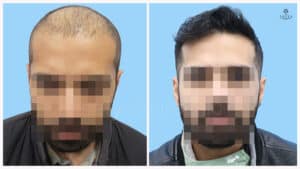 synthetic hair implant