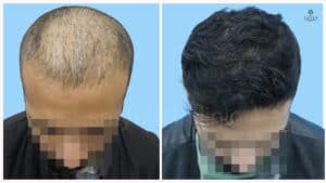 synthetic hair implant