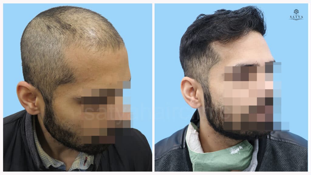 synthetic hair implant