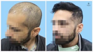 synthetic hair implant