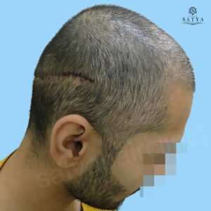 synthetic hair implant