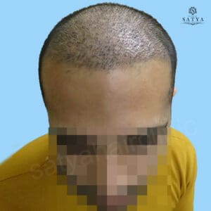 synthetic hair implant