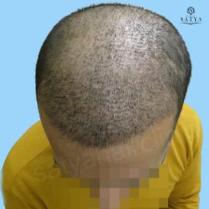 synthetic hair implant