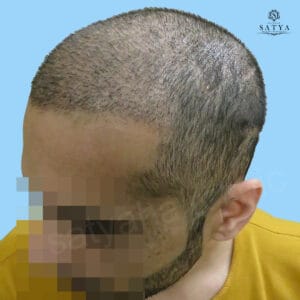 synthetic hair implant