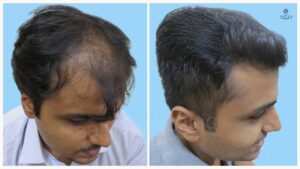 fue hair transplant