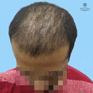 synthetic hair implant