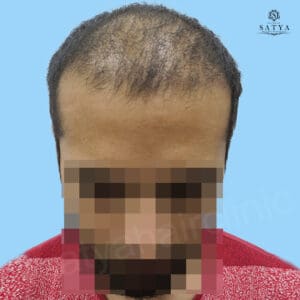 synthetic hair implant