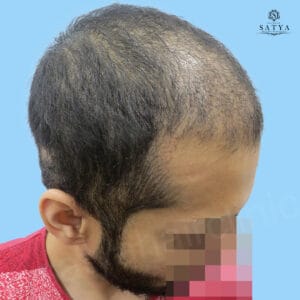 synthetic hair implant
