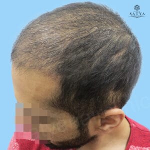 synthetic hair implant