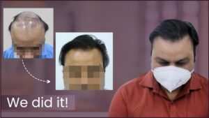 artificial hair implant