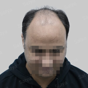 synthetic hair implant