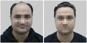 synthetic hair implant